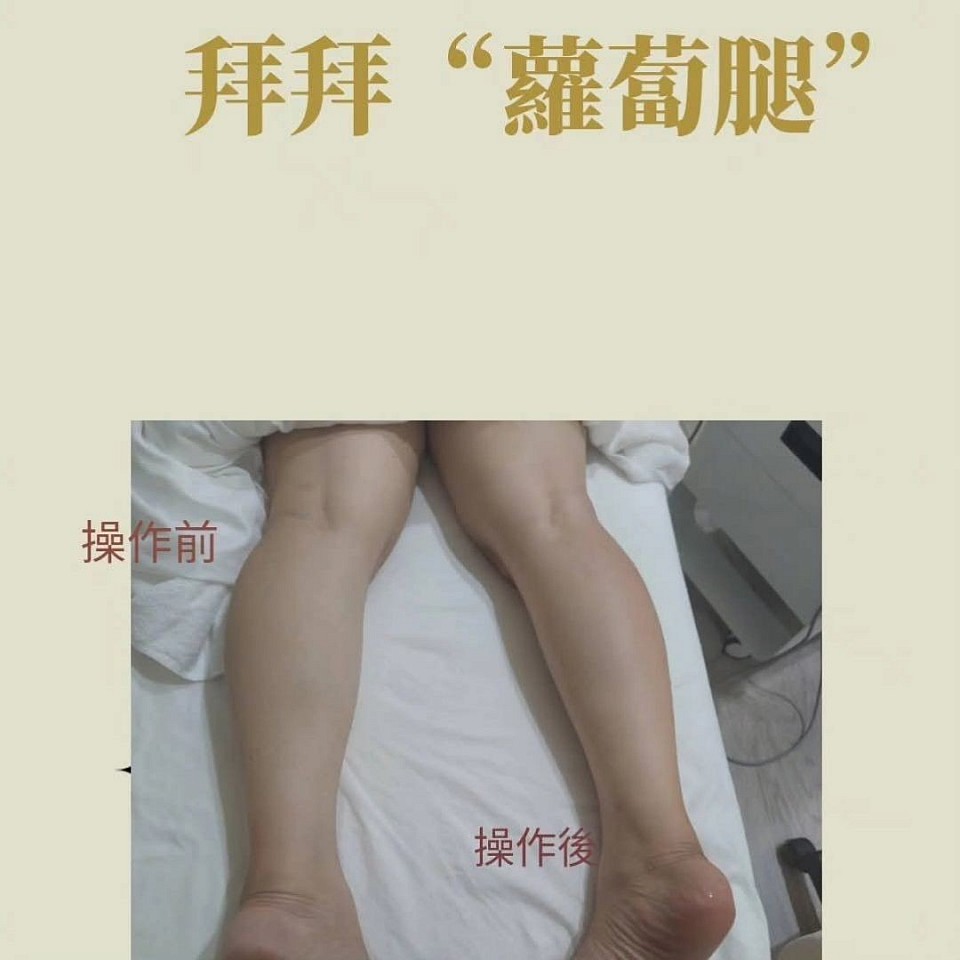 真實客人操作前後對比｜小腿變細、浮腫消除、蘿蔔腿有感改善
