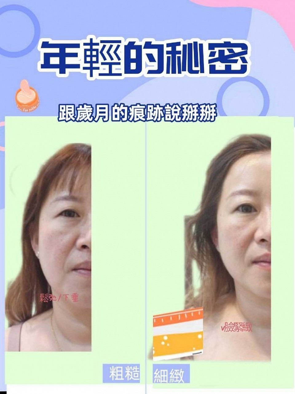 左圖為操作前，臉部下垂、膚質較粗糙； 右圖為操作後，肌膚更透亮、線條拉提自然有感， 真實案例，讓妳輕鬆找回年輕感！