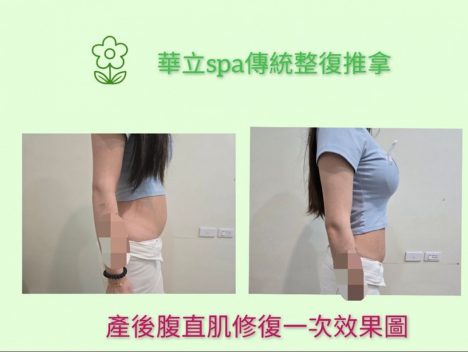 【產後修復推薦】華立SPA結合傳統整復推拿技術，有效針對產後媽媽常見的腹直肌分離問題進行調理。本圖為實際顧客接受一次腹直肌修復療程後的前後對比，改善小腹凸出、核心無力等情況，重拾身體曲線與自信！  🔸 適合對象：產後1個月以上、腹直肌分離輕中度者   🔸 技術特色：無侵入、無痛感、立即有感   🔸 地點：華立SPA｜傳統整復推拿專業團隊