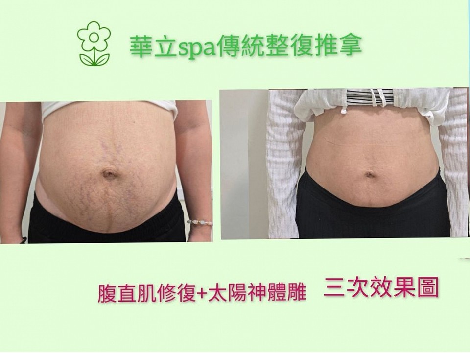 華立SPA傳統整復推拿，腹直肌修復搭配太陽神體雕，三次課程後肚子明顯變小、線條緊緻，改善產後鬆弛與妊娠紋