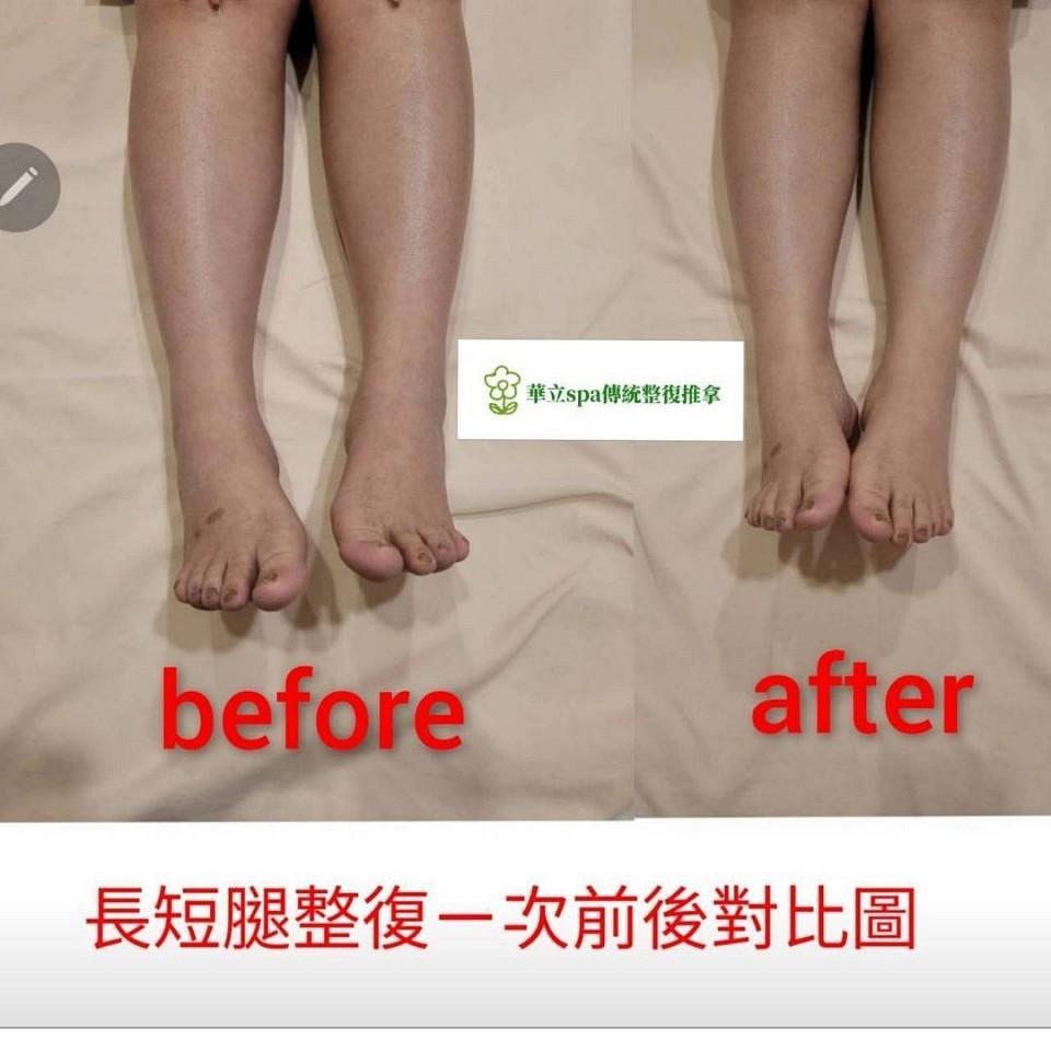 ⚠️ 你以為是長短腳，其實是骨盆早就歪了  走路一邊累、一邊卡 褲管總是左右不一樣長 鞋底永遠先磨同一邊  不是錯覺 是身體真的不平衡。  📌 骨盆傾斜 📌 肌肉代償 📌 越走越歪、越坐越痛  很多人拖到 腰痛、膝蓋痛、屁股痠 才發現不是腿的問題 是整個結構早就亂了。