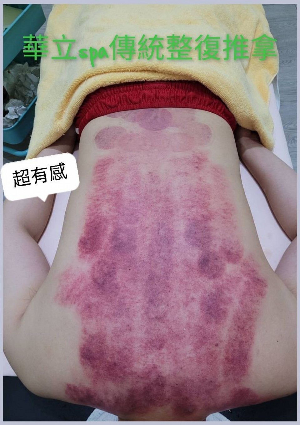 ⚠️ 不是痠，是體內早就卡住了  肩頸硬、背悶、頭重 怎麼睡都不鬆 怎麼按都只好一下  不是你累 是循環被堵住了。  📌 久坐不動 📌 熬夜、壓力大 📌 氣血走不動，廢物排不掉  刮痧 × 拔罐 把卡在體內的緊繃與悶脹 一次拉出來  華立SPA 羅東刮痧拔罐調理 由專業手法操作 循序放鬆筋膜、促進循環